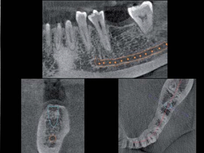 DVT zur Implantatplanung